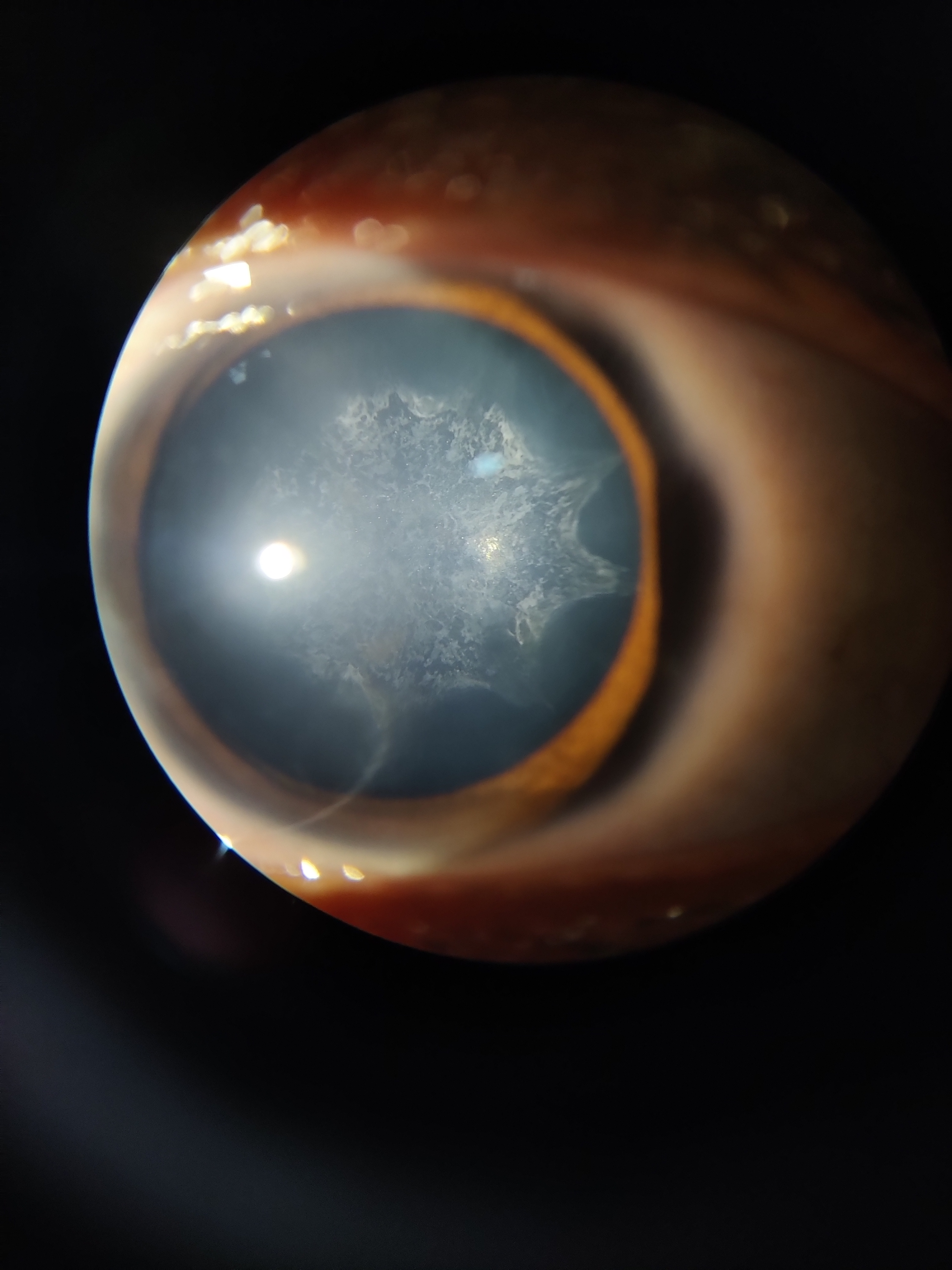 Slit lamp examination under diffuse illumination of a patient with complicated cataract reveals diffuse posterior subcapsular cataract with typical BREADCRUMB appearance and Polychromatic lusture