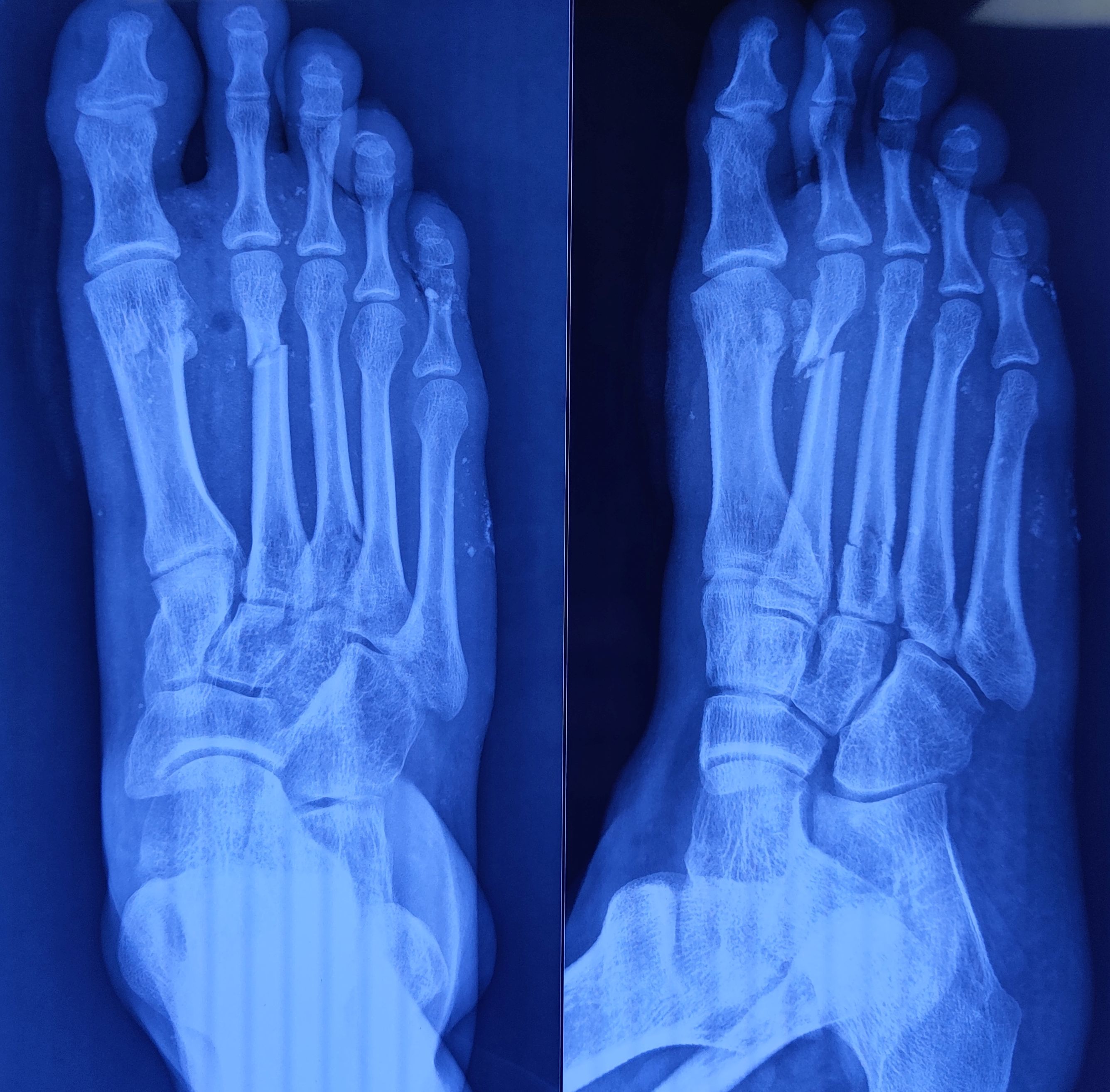 X-ray of right foot anteroposterior and oblique view showing a displaced fracture of distal shaft 2nd metatarsal (>4 mm displacement) and a minimally displaced fracture of proximal shaft 3rd metatarsal