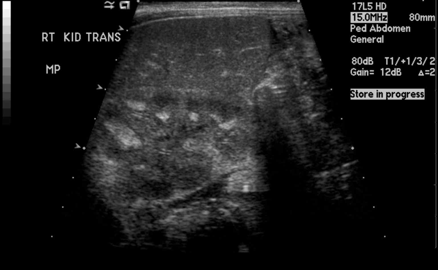 Renal US Medullary Nephrocalcinosis