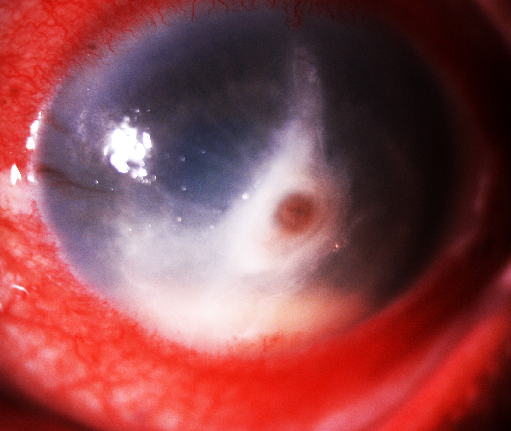 Figure 1-  Slit lamp image depicting conjunctival congestion, 4x3 mm central full thickness infiltrate with corneal perforati