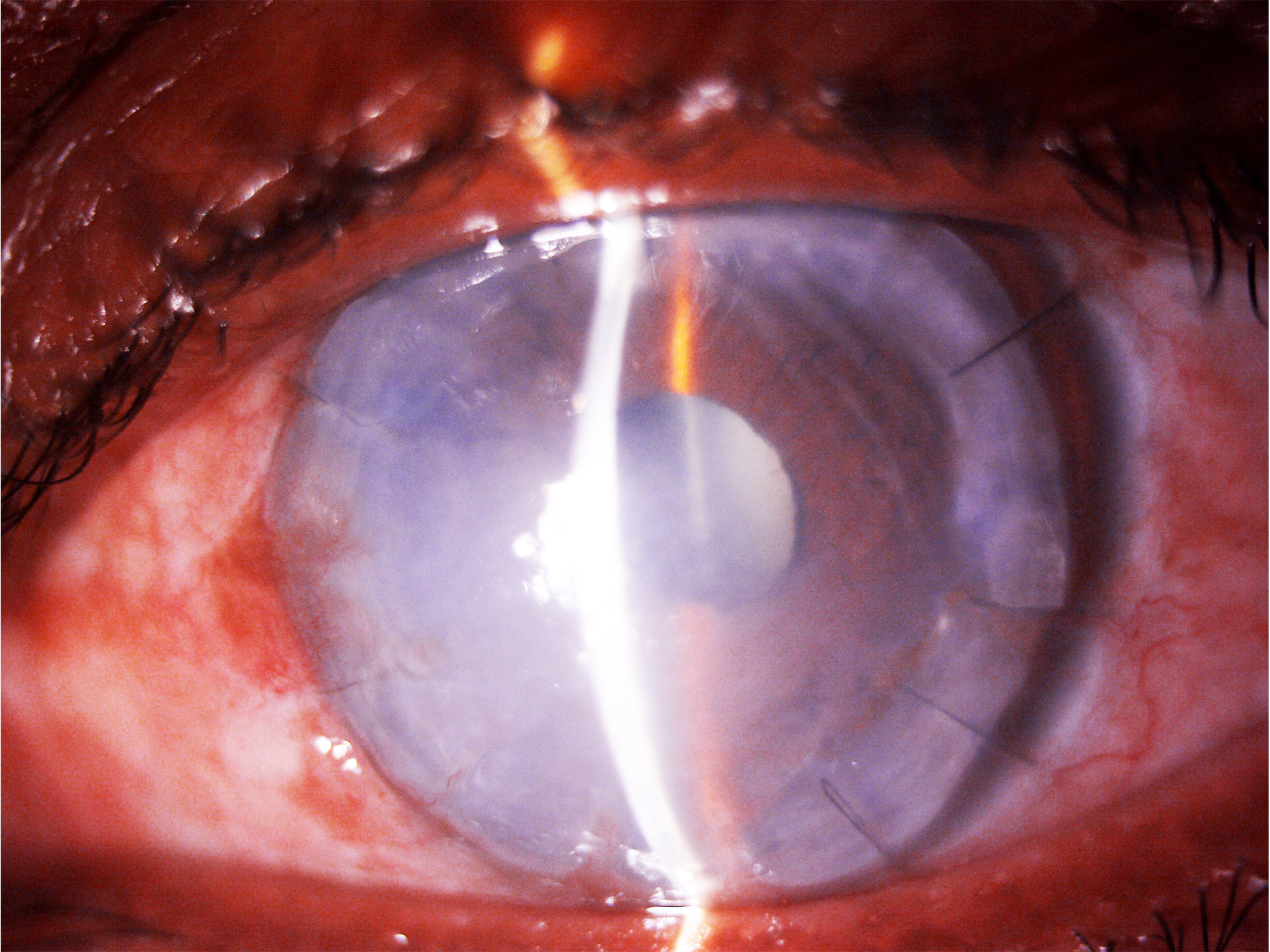 Figure 2- Slit lamp image of a patient of Pythium keratitis post Therapeutic keratoplasty