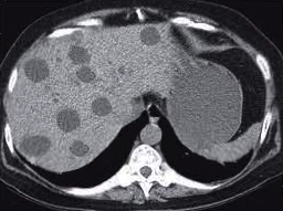 <p>Hepatic Cysts</p>