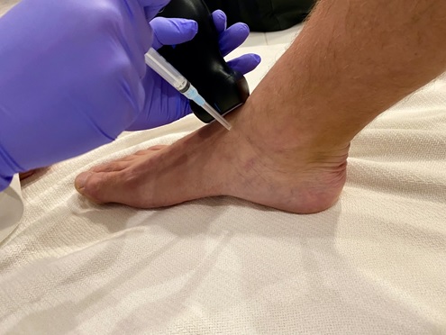 Positioning to perform an ultrasound guided arthrocentesis of the ankle using an out of plane technique