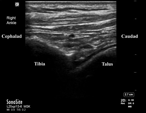 Ultrasound image of a normal ankle