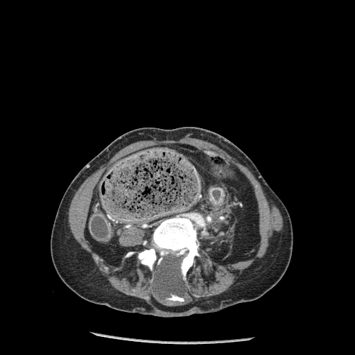 CT Abdomen Myelomenigocele