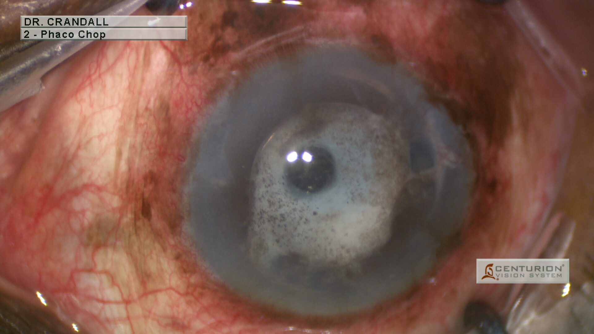 Inflamed cocoon anterior chamber IOL secondary to Uveitis-Glaucoma-Hyphema syndrome (UGH syndrome): UGH syndrome is a rare co