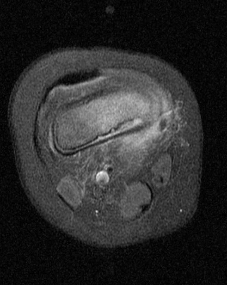 MR T1 Post Contrast Knee MR Osteomyelitis