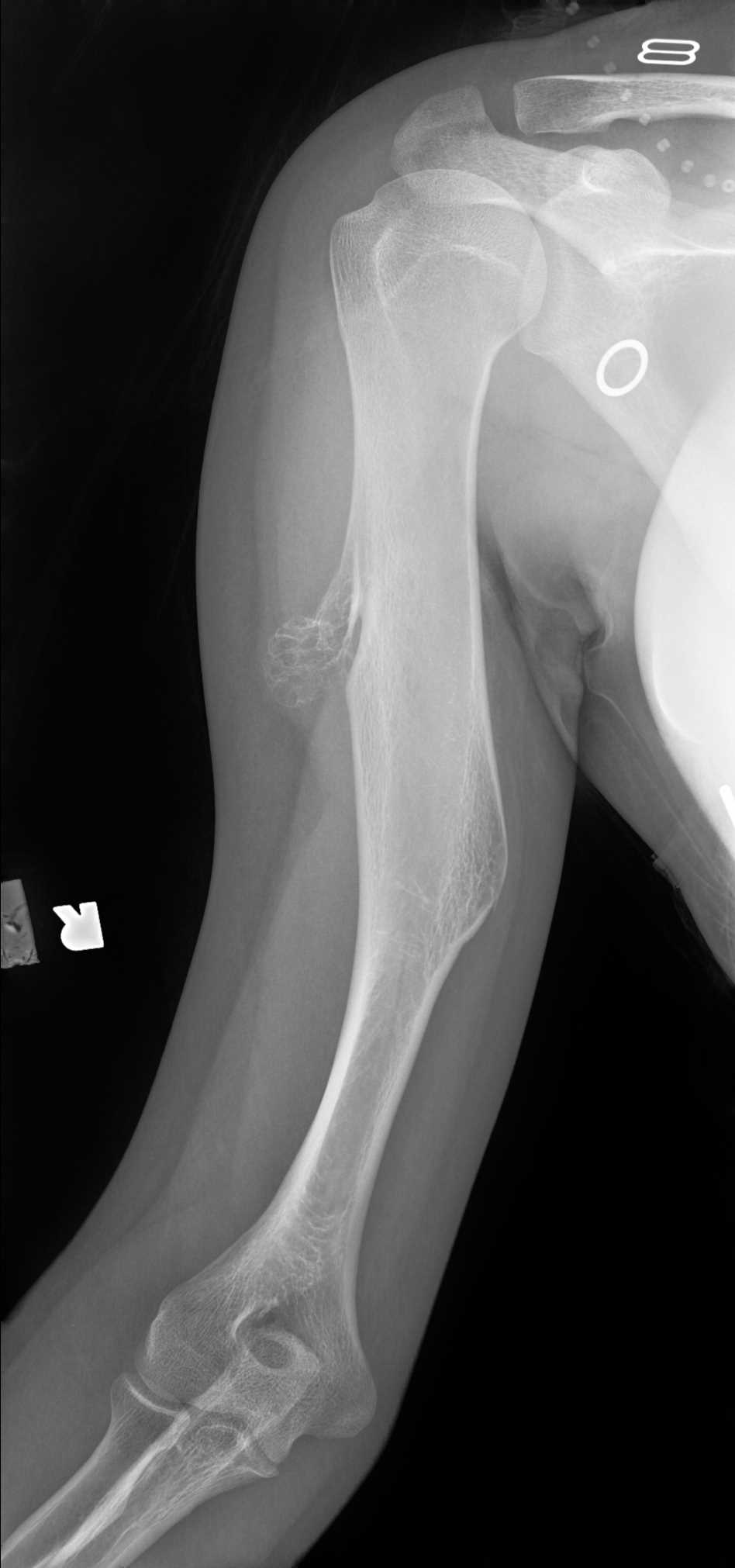 Radiograph Humerus Osteochondroma