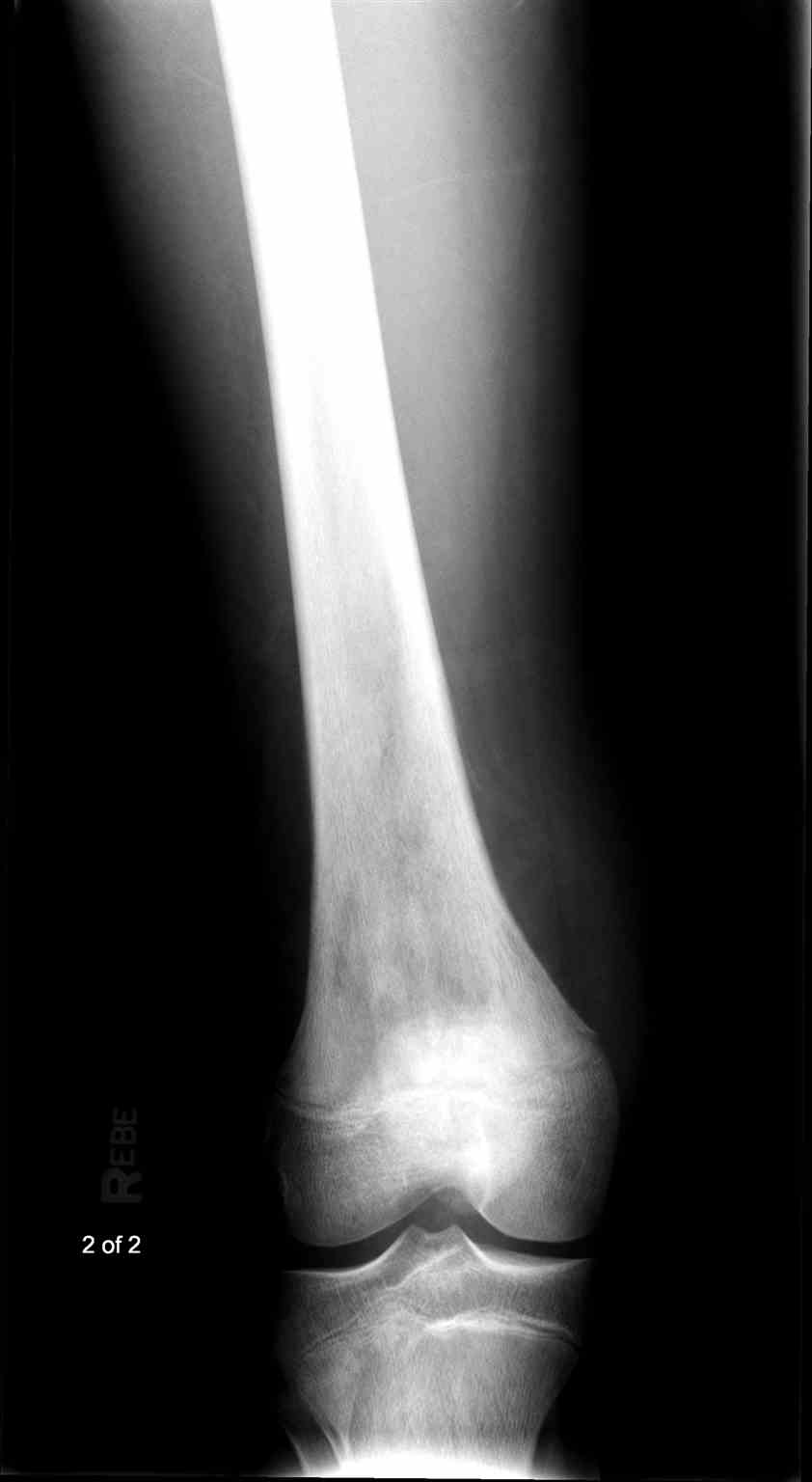 Femur Radiograph Osteosarcoma