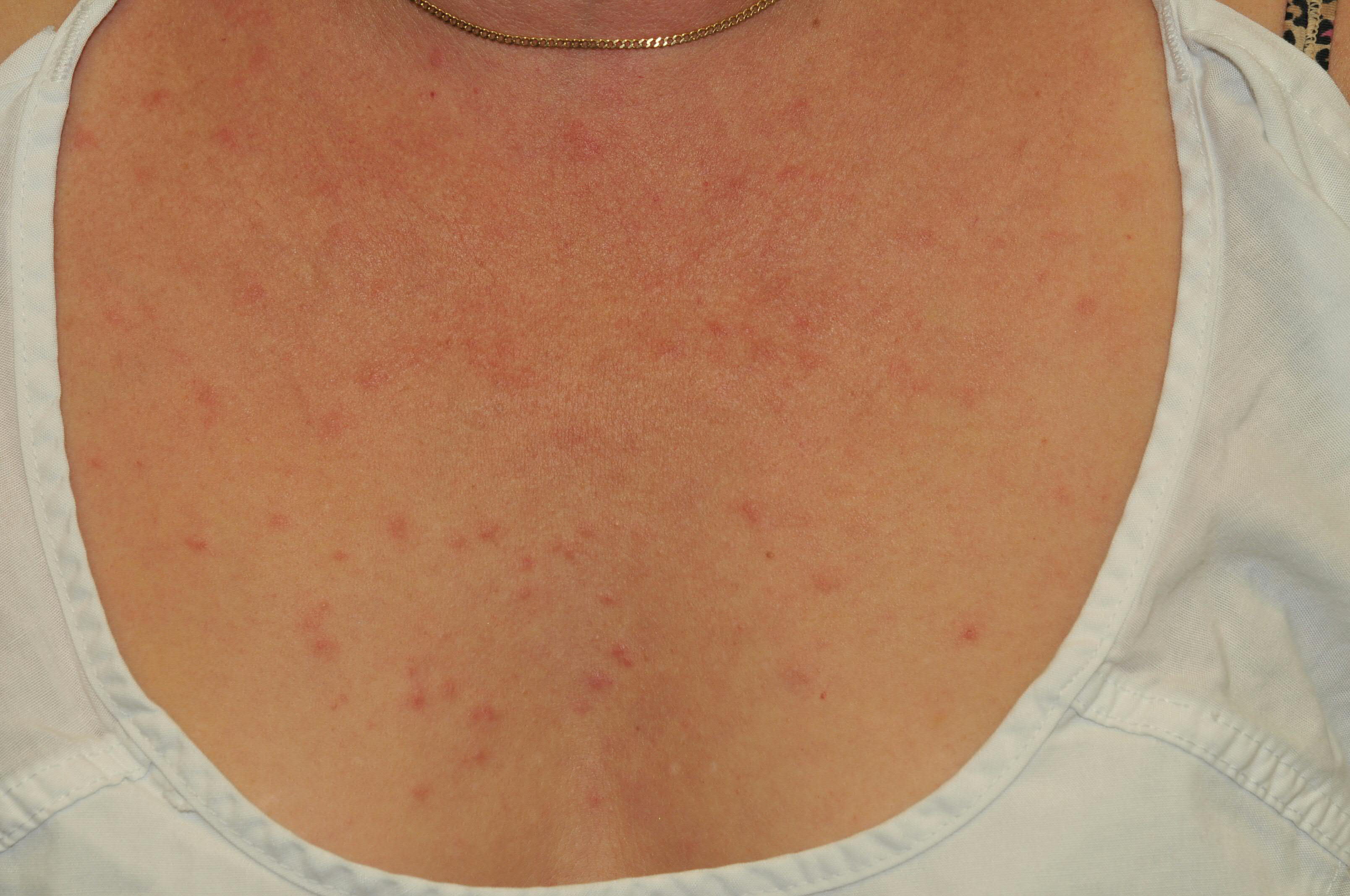 Tumid lupus erythematosus of the upper chest