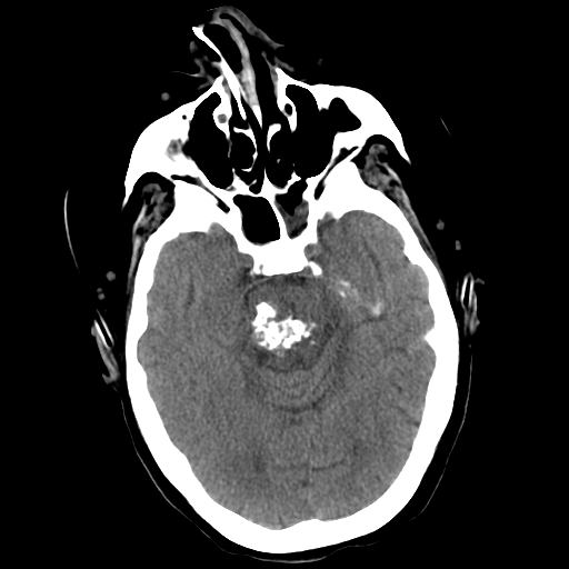 CT head Pons Cavernoma