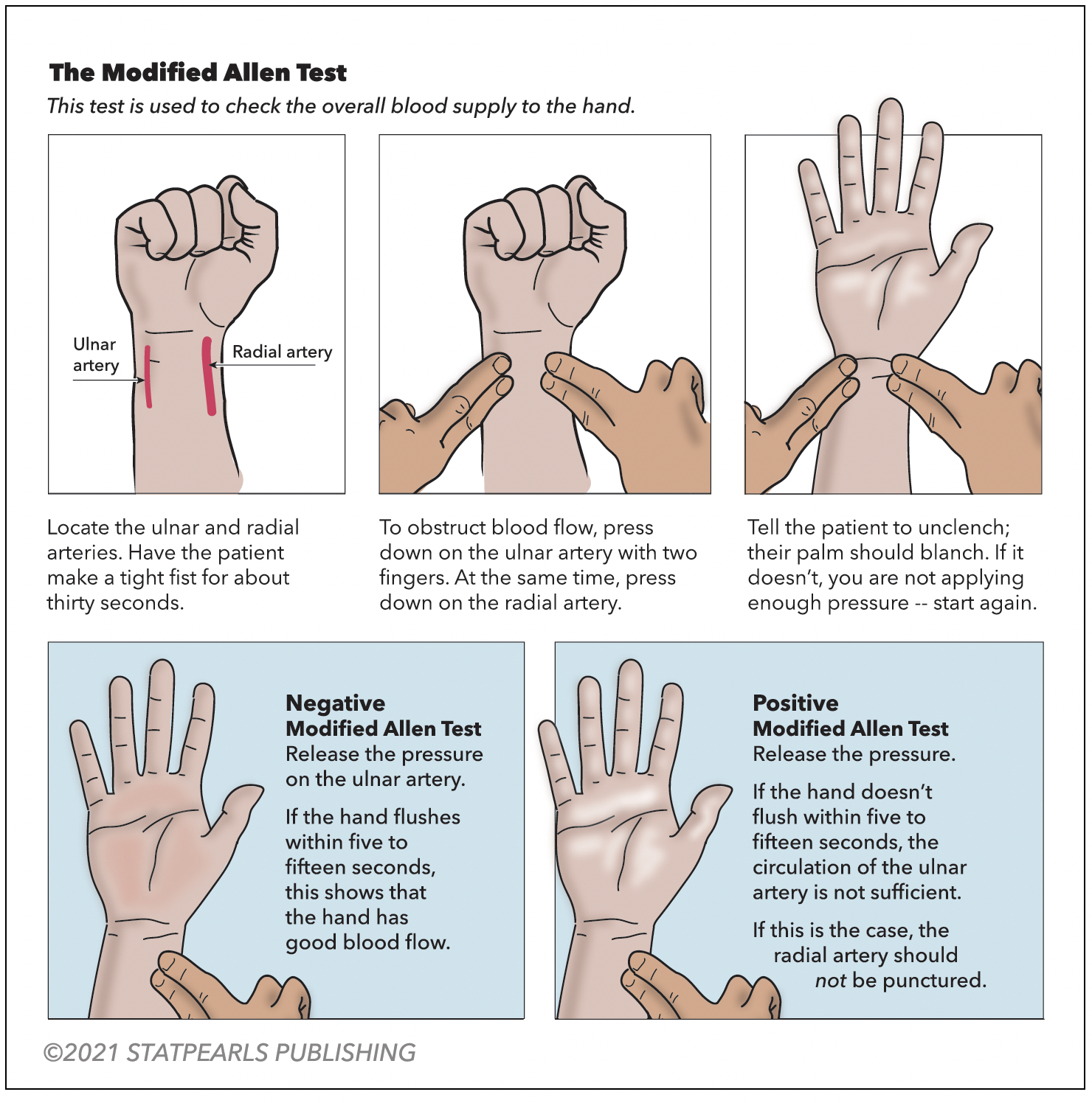 Modified Allen test