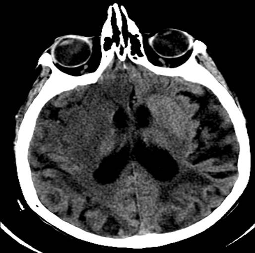 CT head RIght MCA Stroke