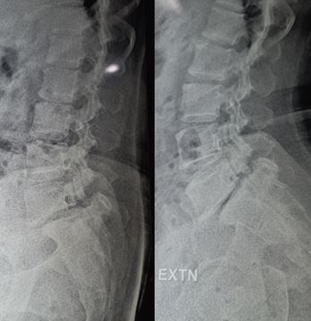 Dynamic X-ray in traumatic spondylolysthesis