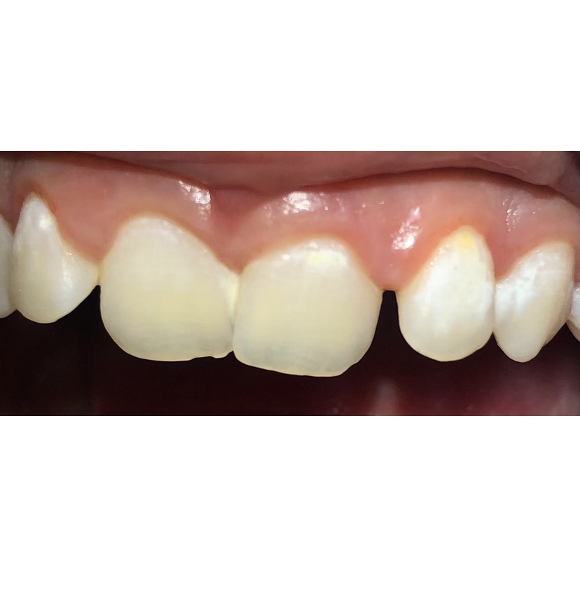 Active initial caries lesions near the gingival margin.