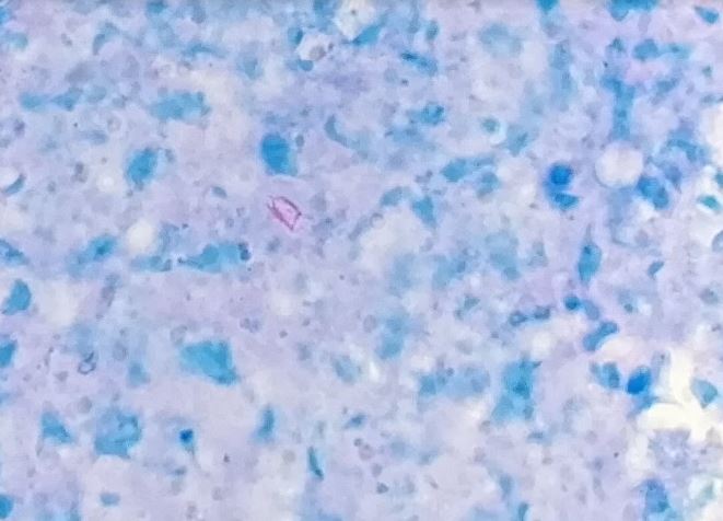 Acid fast bacilli