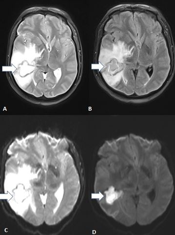 Tuberculoma