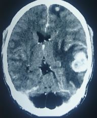 Metastasis from thyroid cancer