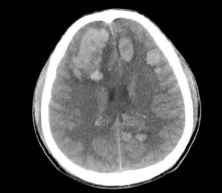 Metastasis from leukemia