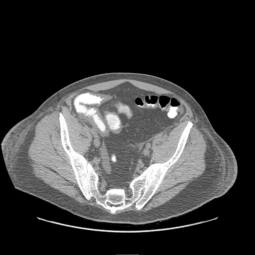 <p>Submucosal Edema in the Abdomen on CT</p>