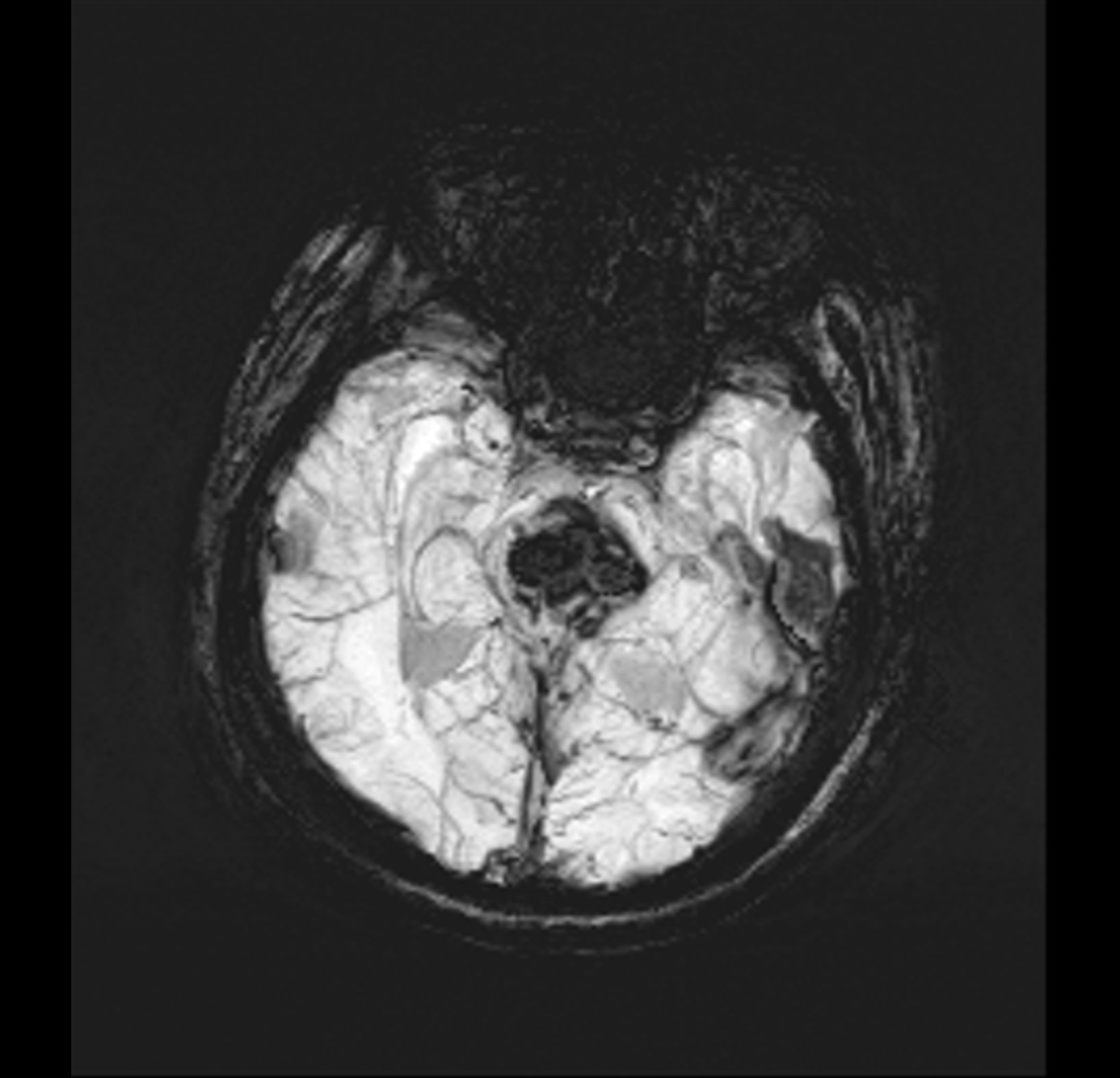 MR SWI sequence in pontine cavernoma