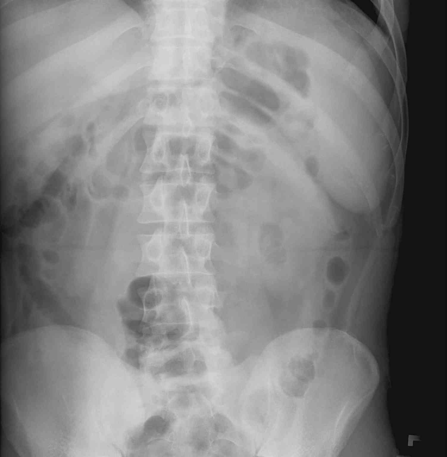 Radiograph Abdomen Splenomegaly