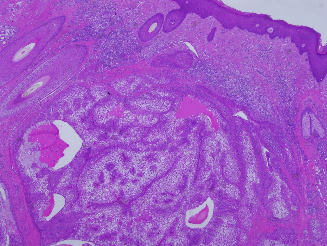 <p>Hidradenoma