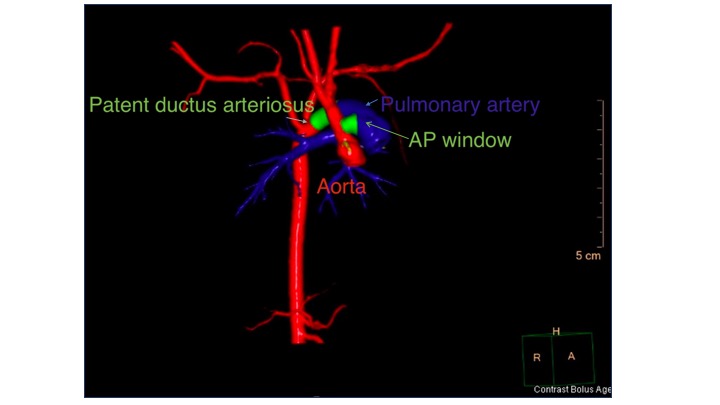 <p>Aortopulmonary Window, Computed Tomography Scan