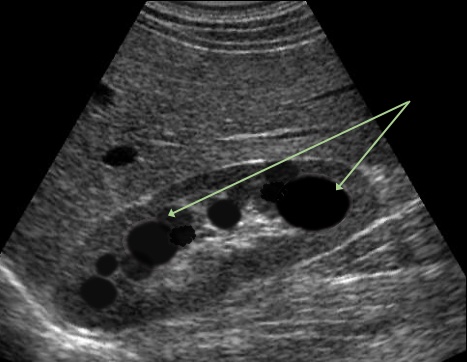 Renal Cyst Ultrasound