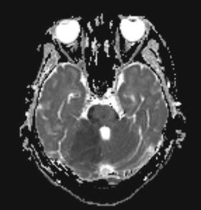 Cerebellar infarction