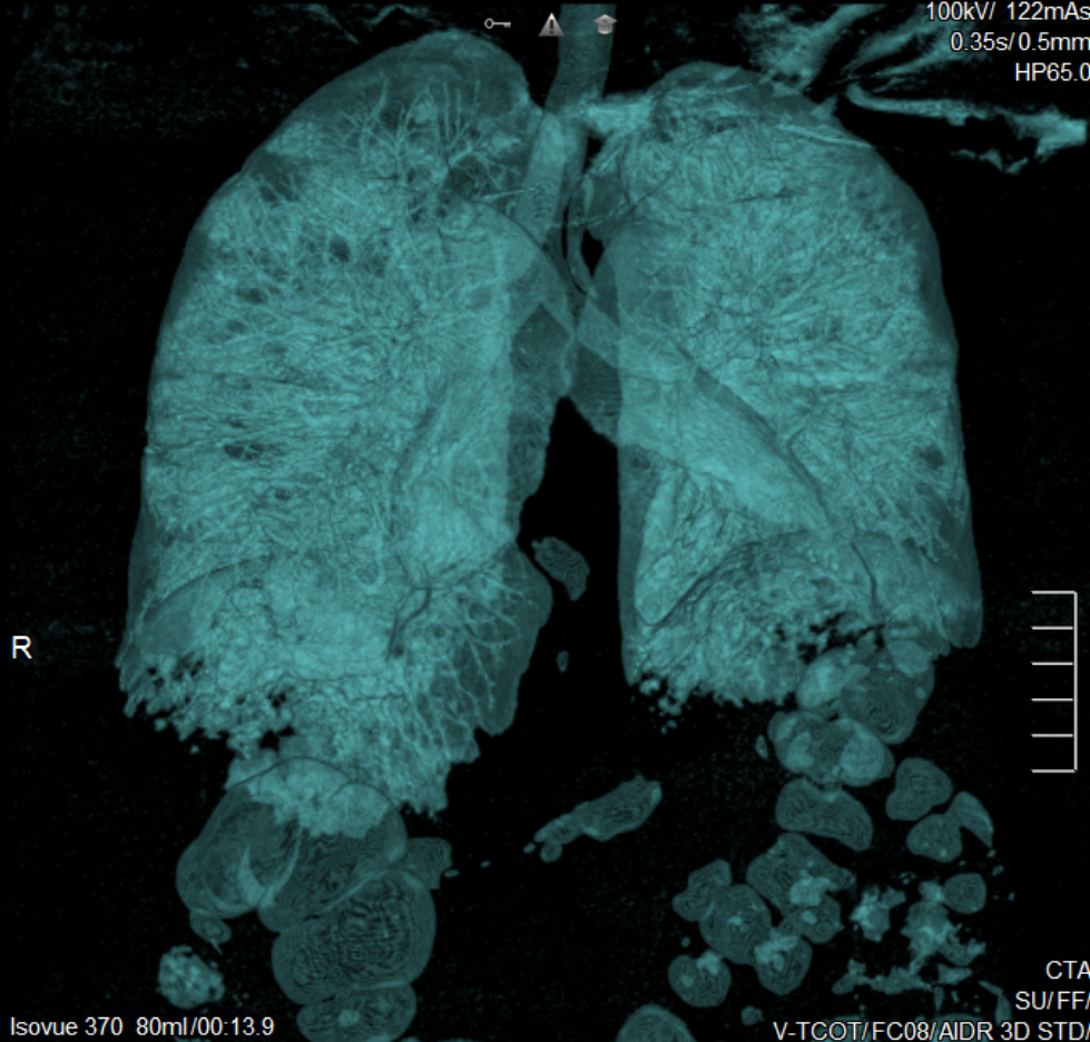 This is a 3D MinIP of the chest and abdomen showing gas filled airways, alveoli, and intestine.