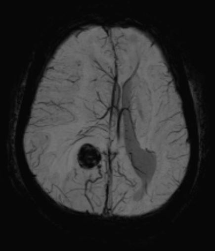 Cortical cavernoma