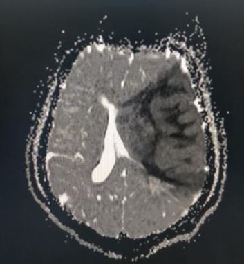 MR ADC sequence in MCA infarction