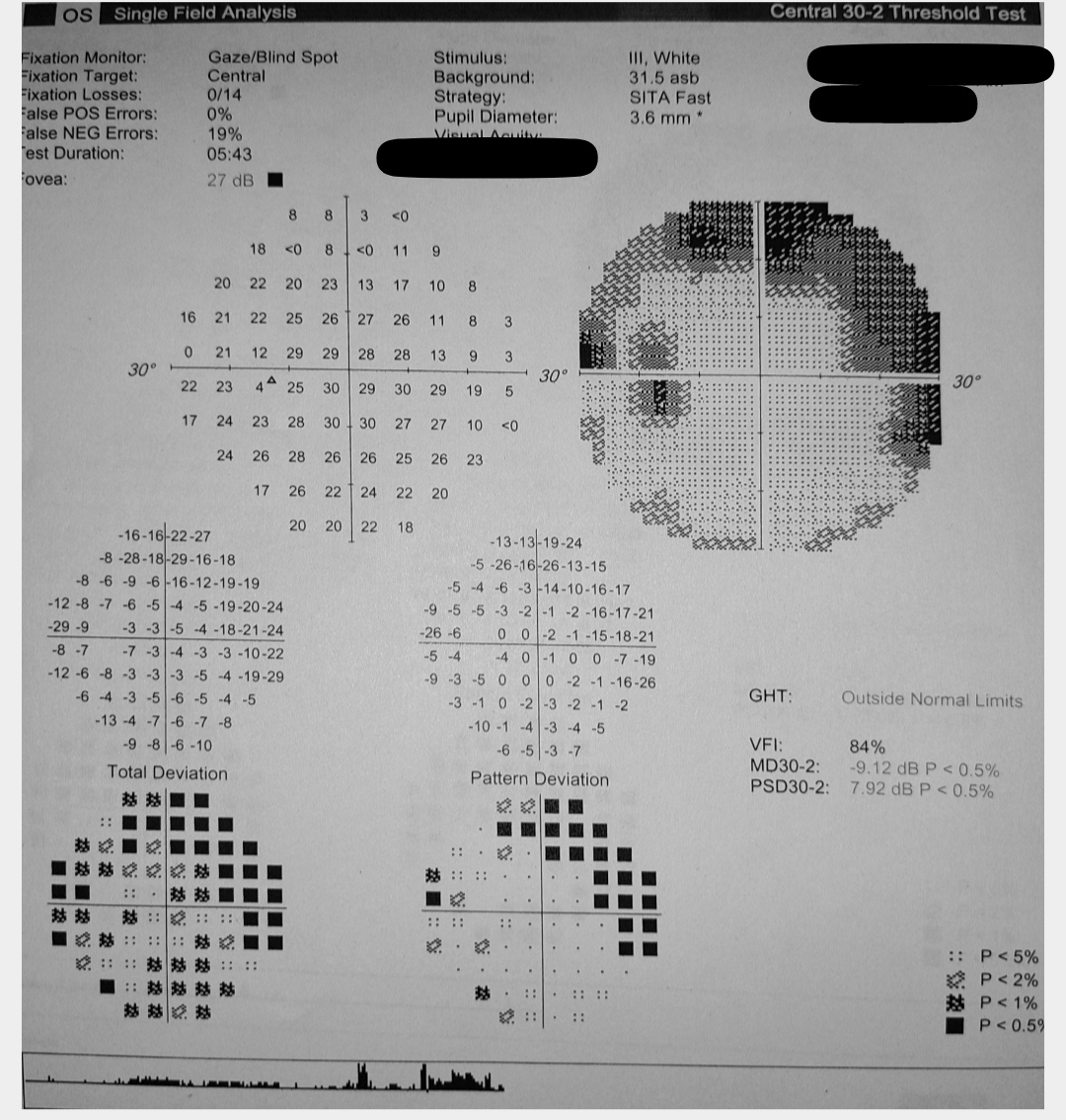 Perimetry left eye - Glaucoma field changes