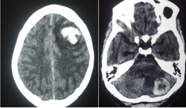 Choriocarcinoma metastasis to brain