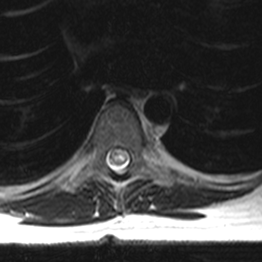 MR Spine T2 Axial Transverse Myelitis