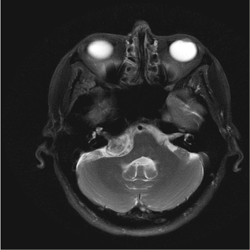 MR Head T2 CP angle Tumor