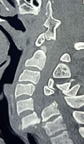 Traumatic cervical C6-C7 spondyloptosis