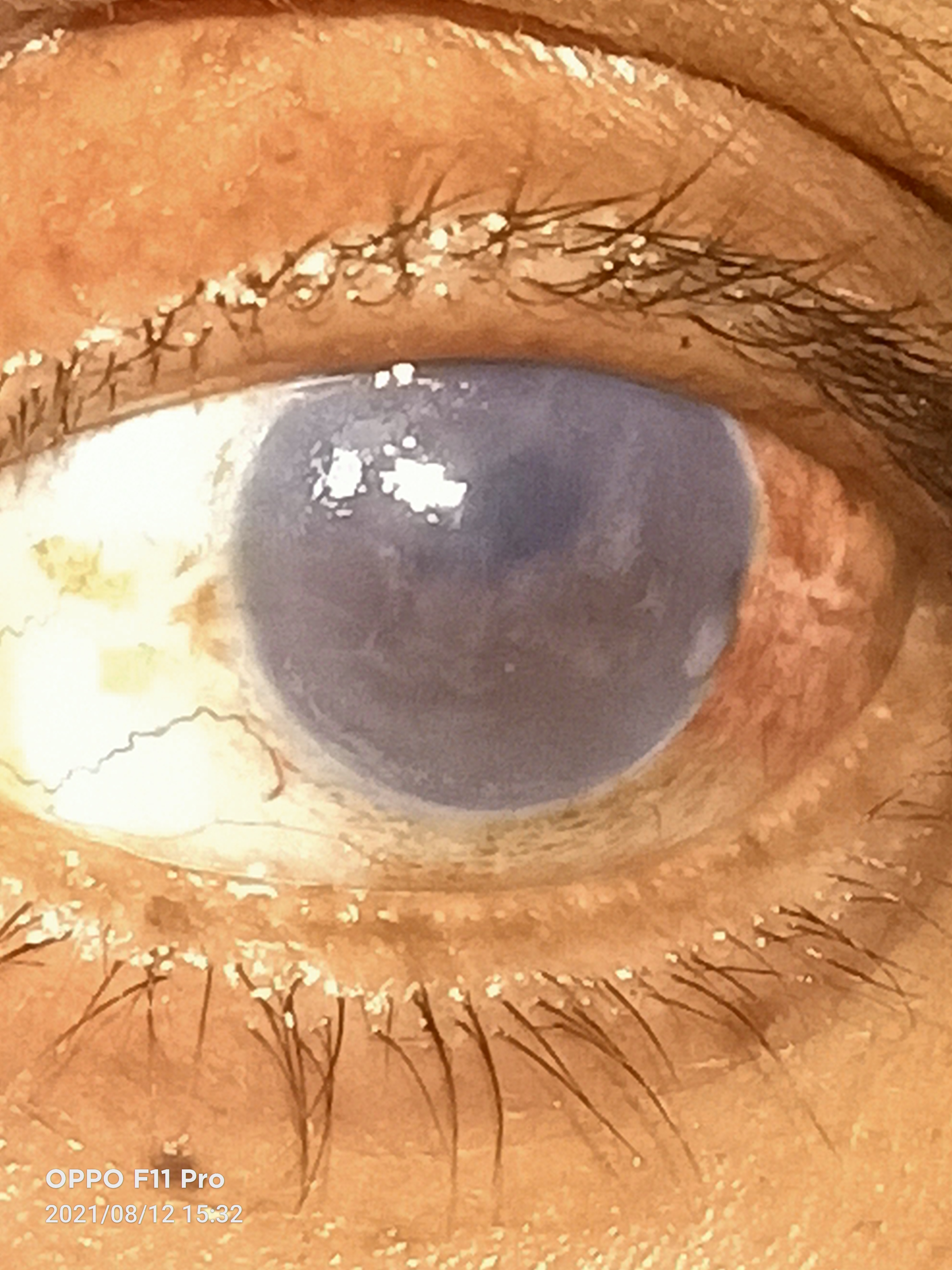 Slit lamp image of the patient depicting sub-epithelial scarring, minimal stromal edema, endothelial decompensation along wit