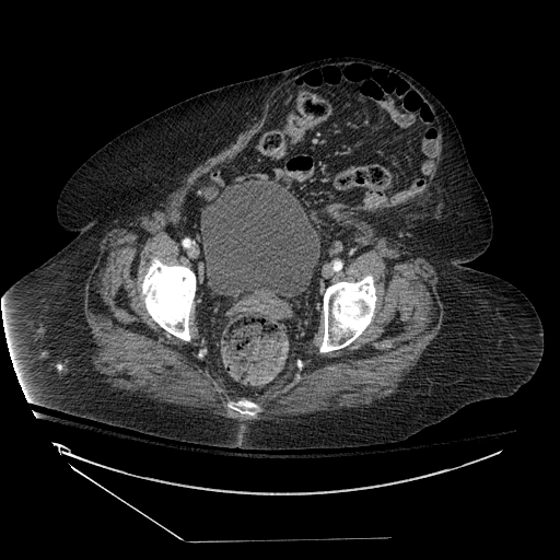 CT Abdomen Ventral Hernia