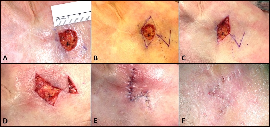 Rhombic flap for Mohs defect of the right cheek