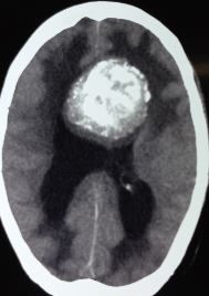 Oligodendroglioma