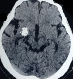 Temporal cavernous angioma