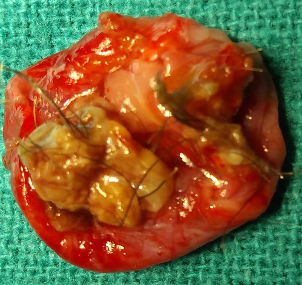 Dermoid cyst