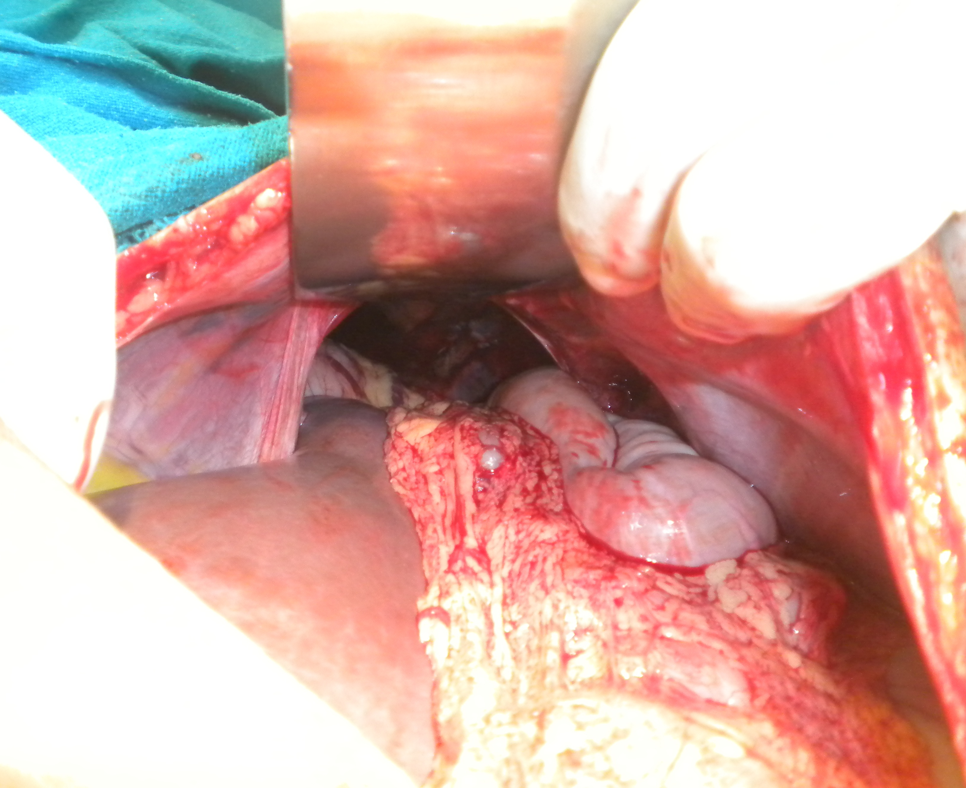 Traumatic diaphragmatic hernia