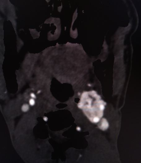 Shamblin grade 3 carotid body tumor