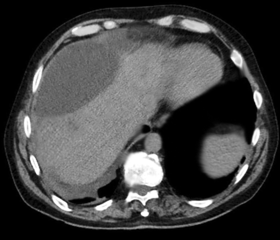 <p>Hepatic Biloma. This CT image shows hepatic biloma.</p>