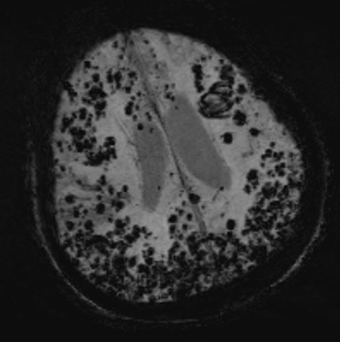 Disseminated cerebral amyloid angiopathies