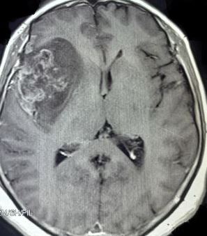 Peri-opercular GBM