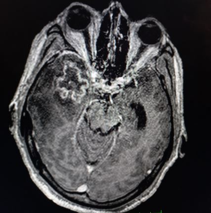 Temporal region GBM